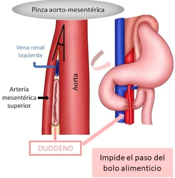 belyreb's tweet photo. SINDROME DE LA PINZA AORTO-MESENTERICA O SINDROME DE WILKIE‼️
Alguna vez has escuchado este nombre? Se trata de la compresión del duodeno secundario a la disminución del ángulo entre la aorta y la arteria mesenterica superior. Abro hilo🧵 https://t.co/tFlWLl9ZE3