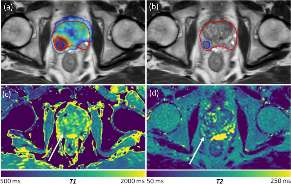 Elekta's tweet photo. #BgRT is all about using an individual’s biological information to personalize their treatment. Read how investigators from @MDAndersonNews, @MSKCancerCenter and @NYULH_RadOnc found that daily adaptive RT, using biology-driven imaging on Elekta Unity, is feasible and may improve upon current clinical methods for target localization and response assessment. https://t.co/maa9P7EPBO
