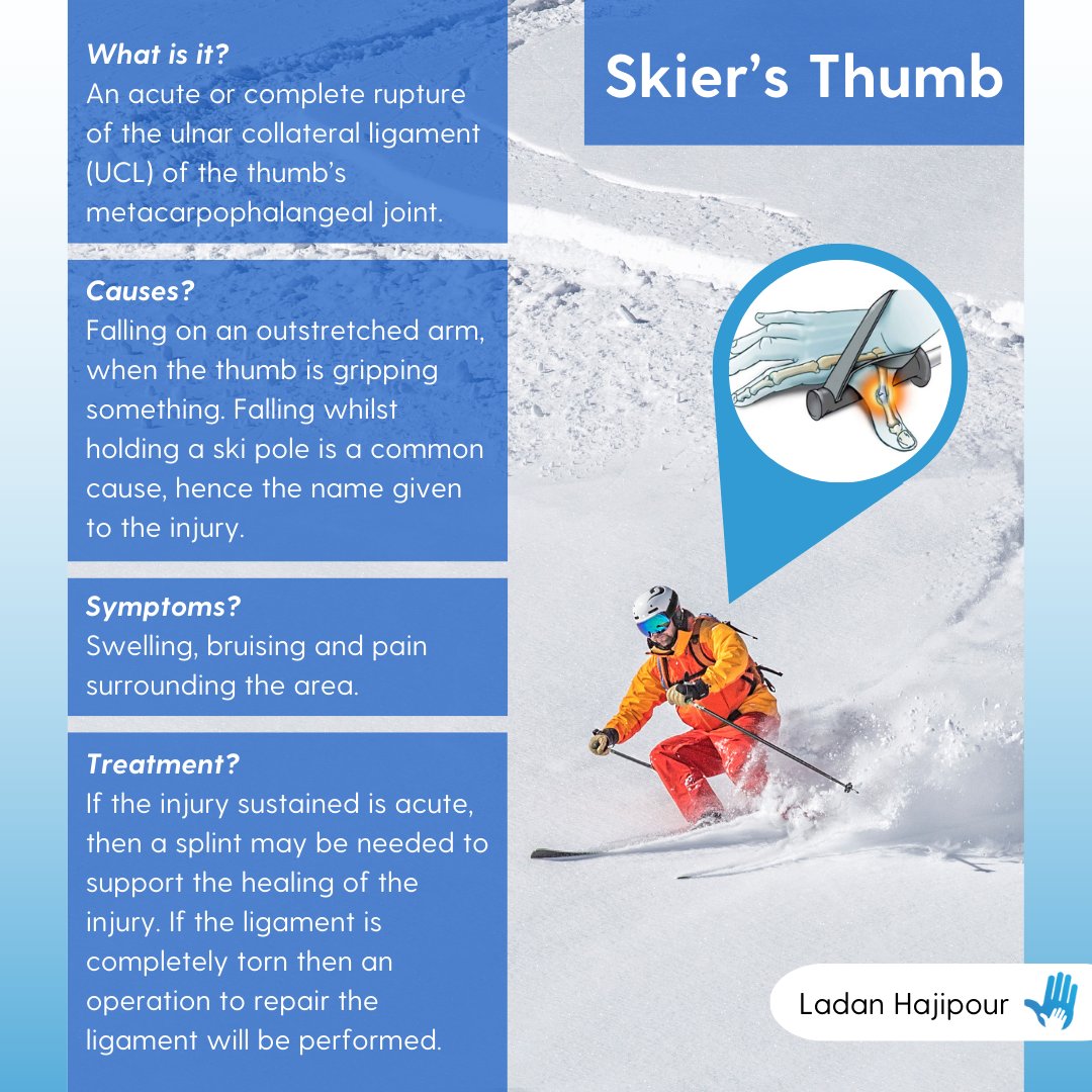 December is here, and many of us are gearing up to hit the slopes! But before you do, it’s important to stay mindful of potential injuries. ⛷️

If you are experiencing pain in line with skier's thumb, book an appointment ladanhajipour.com/book-appointme…. 

#SkiersThumb #HandInjury #Skiing