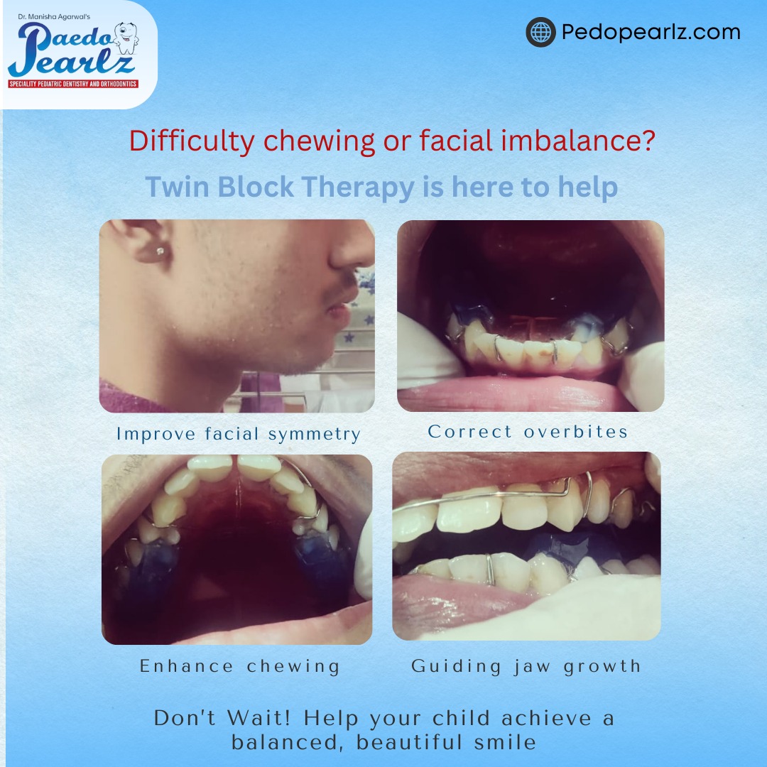 Paedopearlzden's tweet image. Transform your child’s smile with Twin Block Therapy! Correct overbites, improve jaw alignment, and boost confidence with a simple, effective solution. 
.
🦷✨ #TwinBlockTherapy #OverbiteCorrection #HealthySmiles #OrthodonticsForKids #ConfidentSmiles #JawAlignment #PediatricOr...