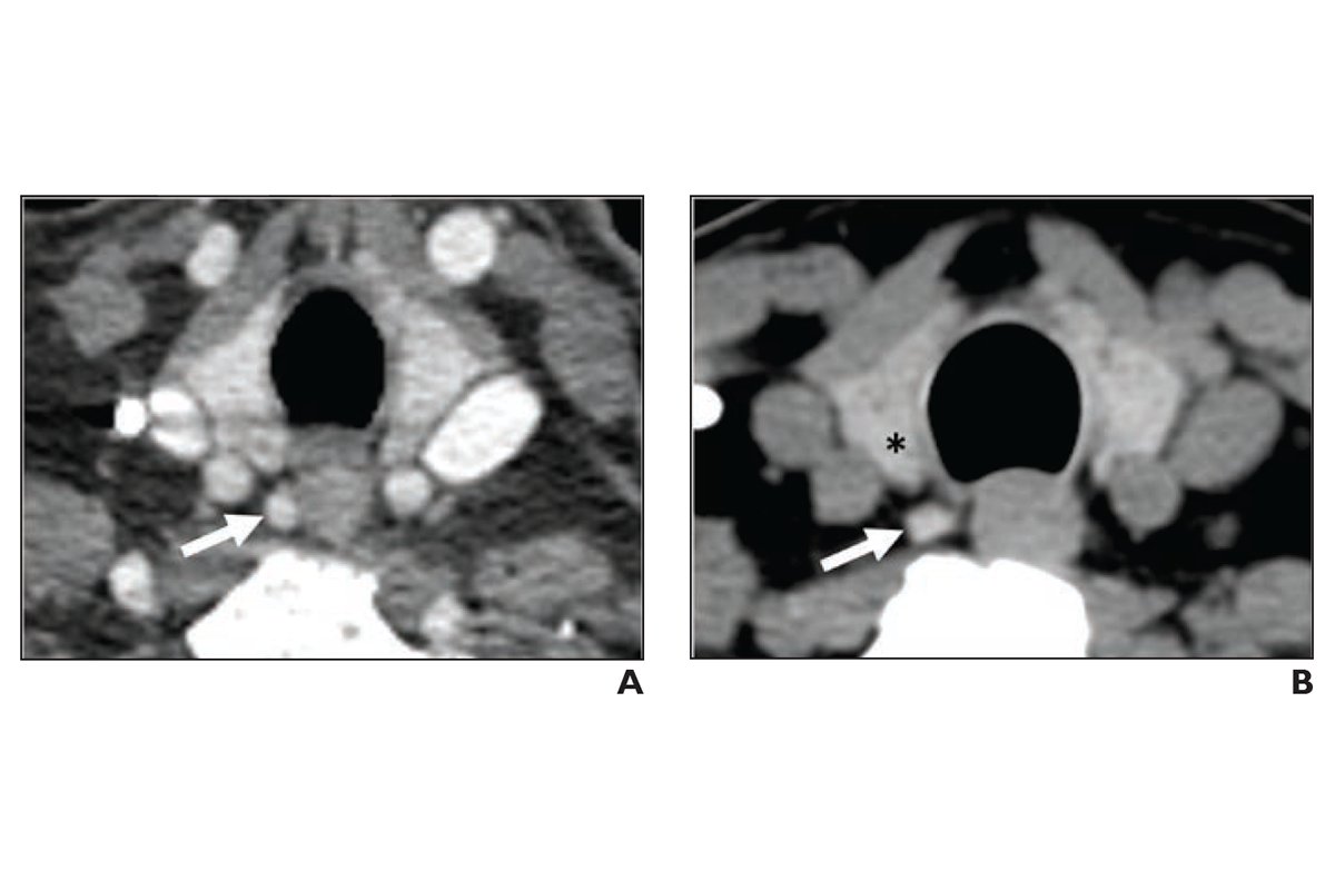 Opportunistic CT-based assessment can identify patients more likely to develop clinically significant complications of PHPT that are potentially preventable through earlier diagnosis and intervention.

ajronline.org/doi/10.2214/AJ…