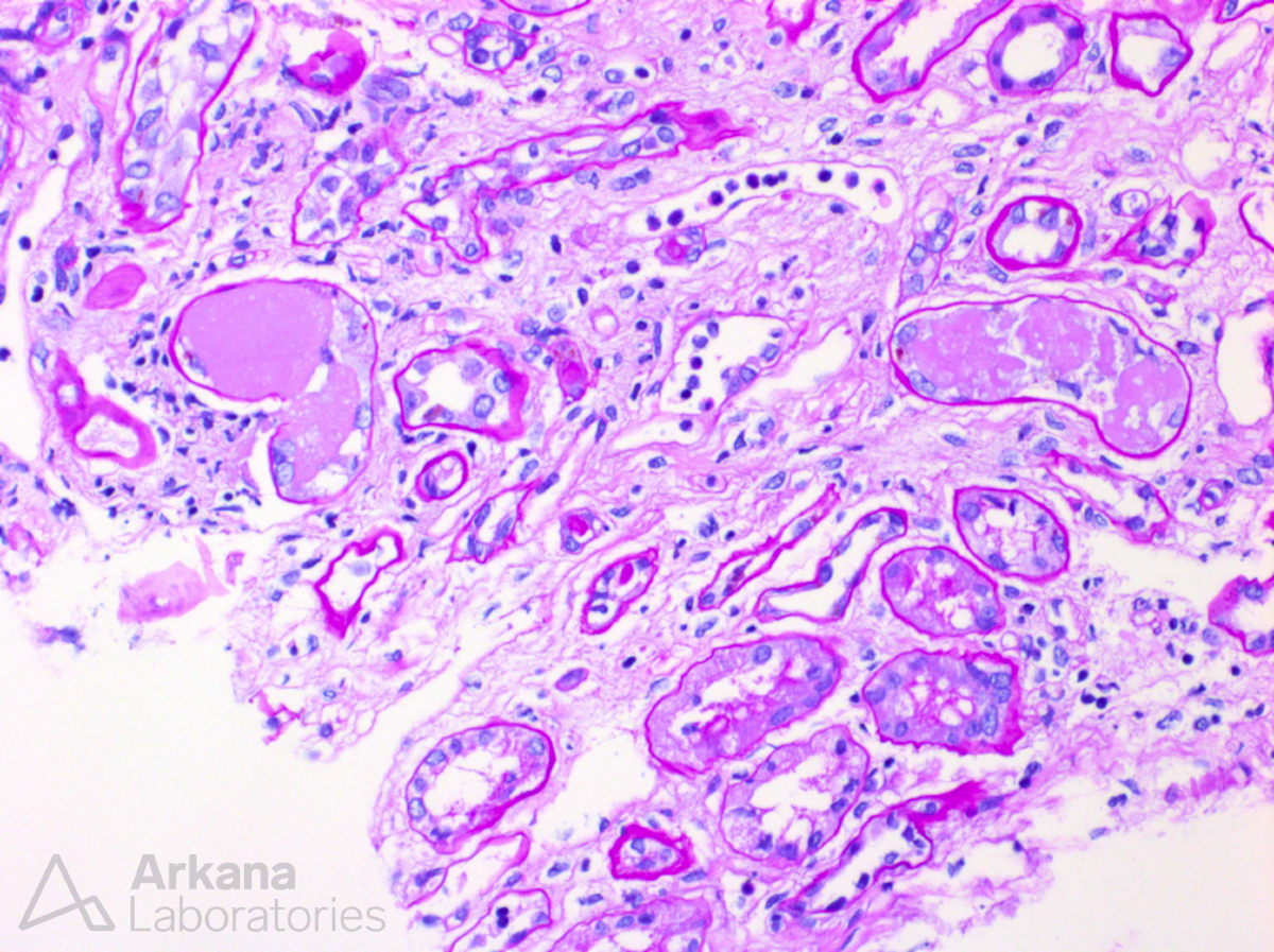 arkanalabs's tweet image. What is your diagnosis and what do you need to prove it?

#DiagnoseThis #renalpath #nephropath