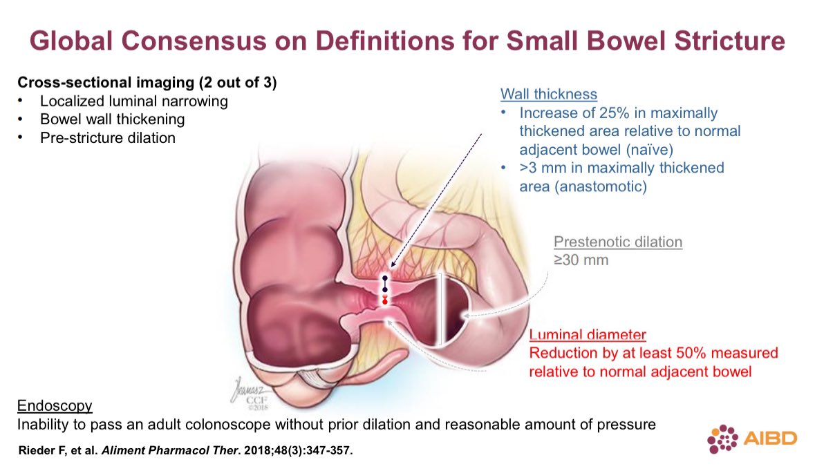 Cathy Lu (@cathylumd) on Twitter photo Is ✂️ always needed for intra-abdo CD abscesses?
✅In most cases, ✂️ is needed urgently or in short term due to strictures.
✅abscess < 3cm,no stricture, new dx, Bionaive may respond to meds
✅only 36% avoid ✂️> 2 years if pre-stenotic dilation > 3cm <a href="/MRegueiroMD/">Miguel Regueiro</a> #AIBD2024 Is ✂️ always needed for intra-abdo CD abscesses?
✅In most cases, ✂️ is needed urgently or in short term due to strictures.
✅abscess < 3cm,no stricture, new dx, Bionaive may respond to meds
✅only 36% avoid ✂️> 2 years if pre-stenotic dilation > 3cm <a href="/MRegueiroMD/">Miguel Regueiro</a> #AIBD2024