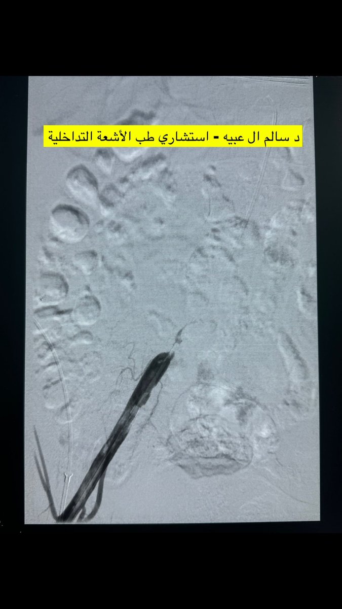 Saq712's tweet photo. إعادة فتح وتركيب دعامه لإنسداد كامل في الشريان الخارجي للحوض الأيمن عن طريق #الاشعة_التداخلية .
Recanalization and stenting of right EIA occlusion (5cm) #TASC B lesion, by using #Nitrex wire #Medtronic and #VBX stent #Gore .
#تجمع_نجران_الصحي #نجران_الآن #SIRS #PAIRS https://t.co/Zt0D2jVos4
