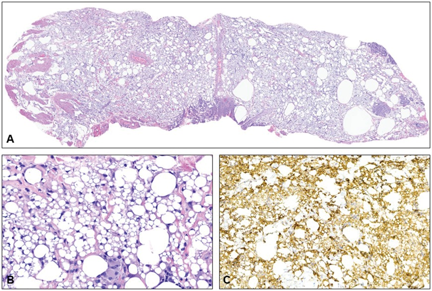 AJDP_Journal's tweet photo. #WhatsNewInDermpath
Silicone on the move: migratory siliconoma after retinal surgery report of a case and review of the literature - among 13 documented instances of silicone oil migration, 6 developed after multiple vitreoretinal procedures
@DermpatGal @UCSFPath @UCSF https://t.co/ap28FBjz8Q