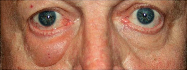 AJDP_Journal's tweet photo. #WhatsNewInDermpath
Silicone on the move: migratory siliconoma after retinal surgery report of a case and review of the literature - among 13 documented instances of silicone oil migration, 6 developed after multiple vitreoretinal procedures
@DermpatGal @UCSFPath @UCSF https://t.co/ap28FBjz8Q