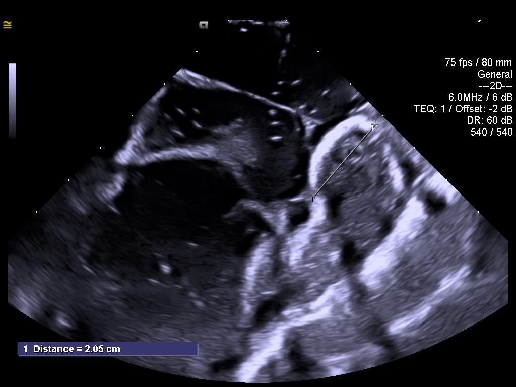 vincenzomirco93's tweet image. First SOUNDSTAR CRYSTAL commercial case in the world performed by Dr @natale_md at St David’s medical center in Austin,TX. #Jnjmedtech #Epeeps