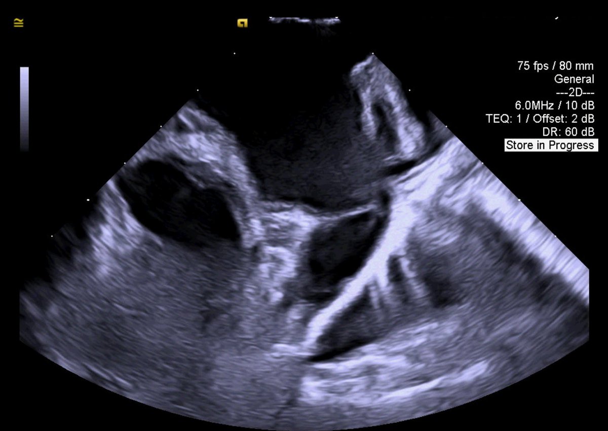 vincenzomirco93's tweet image. First SOUNDSTAR CRYSTAL commercial case in the world performed by Dr @natale_md at St David’s medical center in Austin,TX. #Jnjmedtech #Epeeps