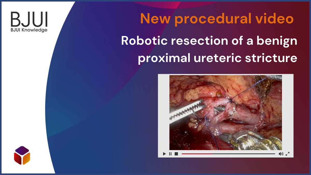 🆕 Expert urologists perform a robotic resection and primary anastomosis of the strictured segment on a 62-year-old woman presenting with intermittent flank pain.  

🎥 Watch the full video as a subscriber: bjui.pub/Robotic-Resect…

#urology <a href="/DrDevangDesai/">Dev Desai</a> <a href="/bennamdarian/">Benjamin Namdarian</a>