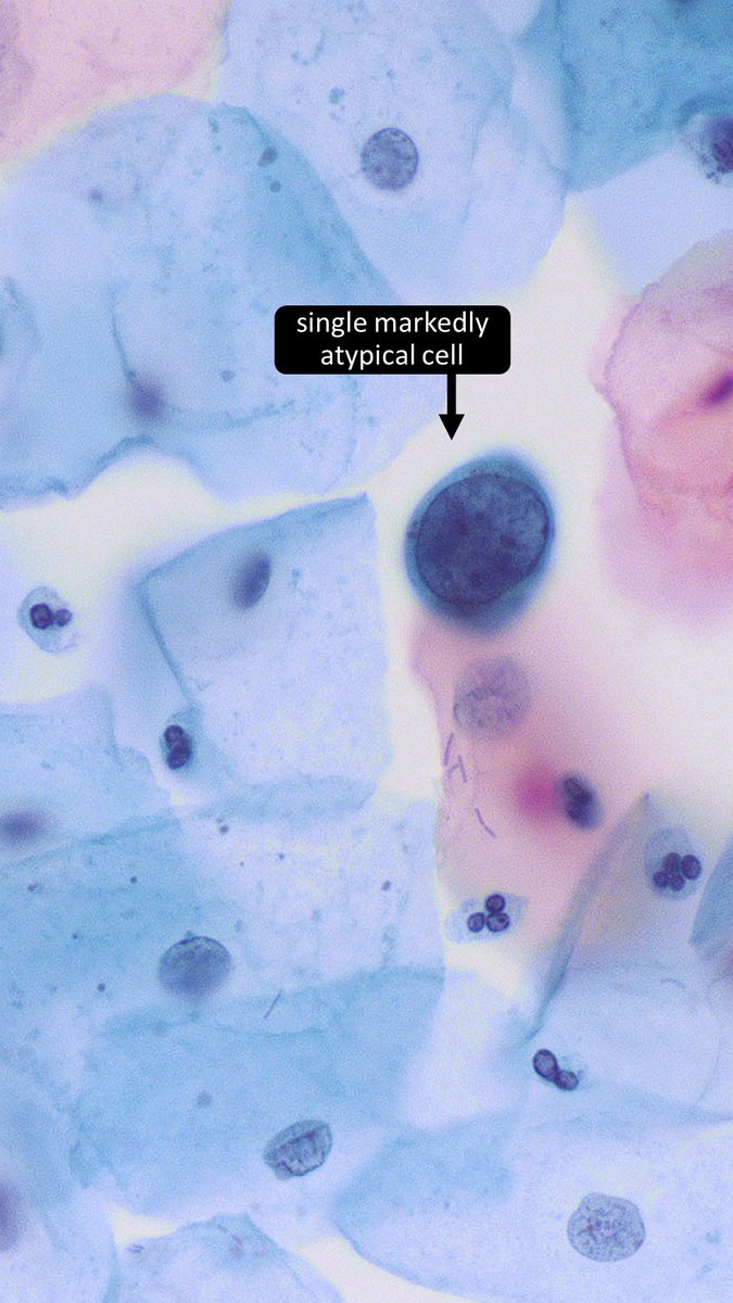 DrCycloPath's tweet photo. Master these cells in my module!↙️↙️↙️
https://t.co/NZE7gaT31o

✅ASC-H
ASC-H is the appropriate category when there are rare cells with nuclear features suspicious for HSIL but not definitive
Even a single high-grade cell warrants classification as ASC-H, ensuring further investigation
ASC-H cells demonstrate nuclear abnormalities raising suspicion but lacking definitive features of HSIL
#CytoPath #GynPath #PathTwitter #pathology