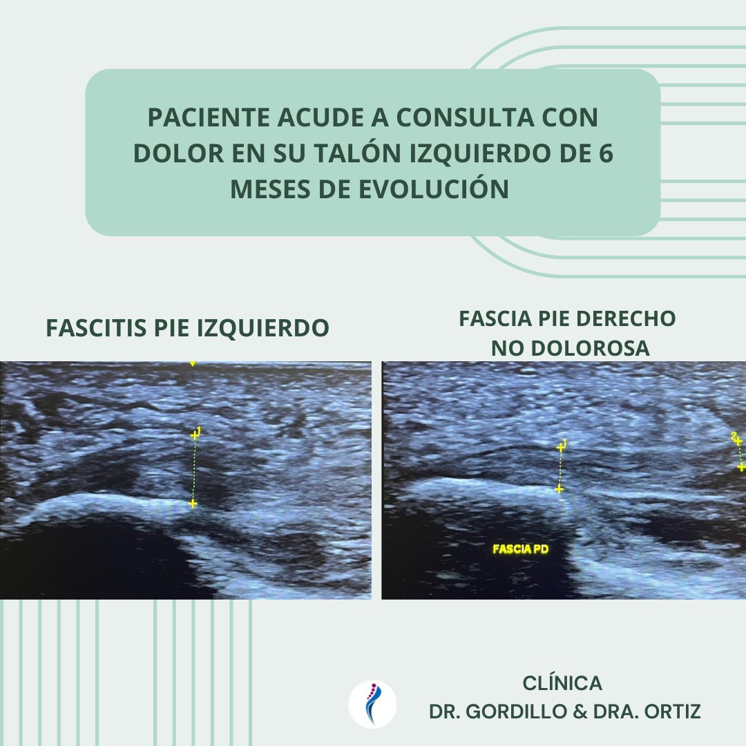 DoctoresDelPie's tweet photo. FASCITIS PLANTAR 👣 https://t.co/GJeeuV1Yrh
