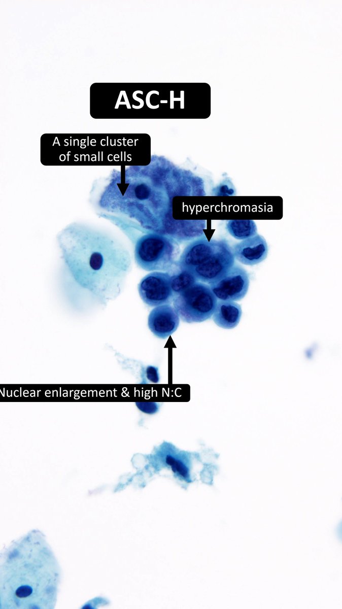 DrCycloPath's tweet photo. Master these cells in my module!↙️↙️↙️
https://t.co/NZE7gaT31o

✅ASC-H
ASC-H is the appropriate category when there are rare cells with nuclear features suspicious for HSIL but not definitive
Even a single high-grade cell warrants classification as ASC-H, ensuring further investigation
ASC-H cells demonstrate nuclear abnormalities raising suspicion but lacking definitive features of HSIL
#CytoPath #GynPath #PathTwitter #pathology
