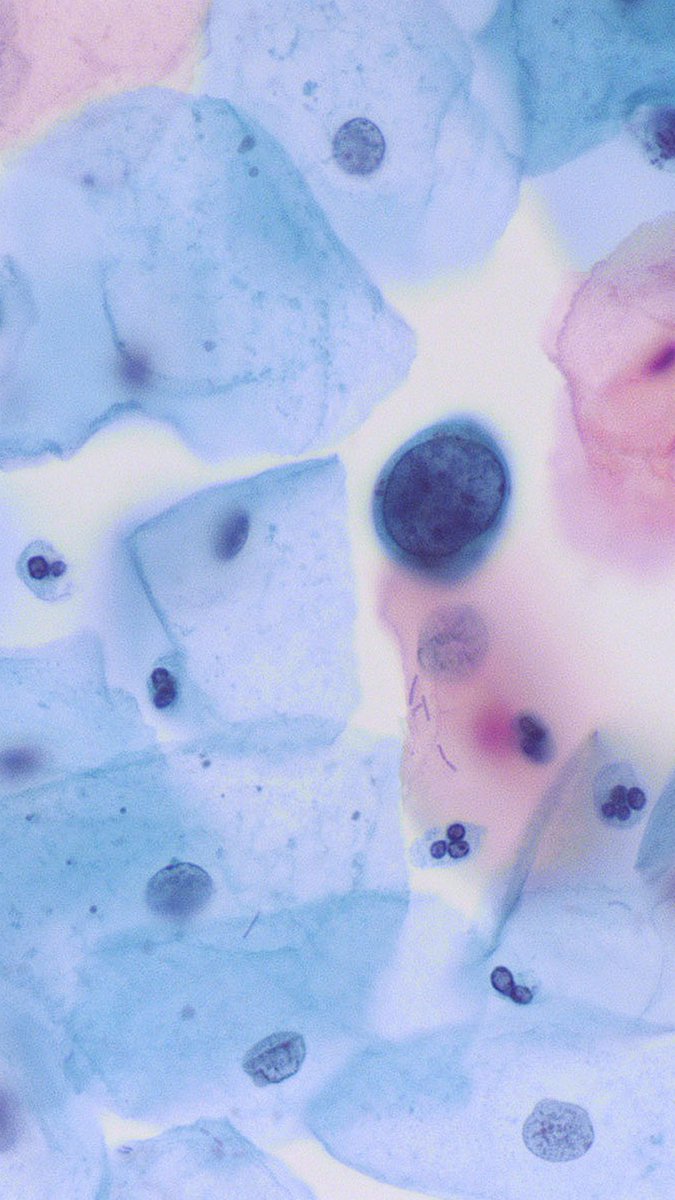 DrCycloPath's tweet photo. Cell from a pap smear, what is your interpretation?🧐
A) ASC-US
B) ASC-H
C) LSIL
D) HSIL
#CytoPath #PathTwitter #Pathology #GynPath https://t.co/Has4wdGDuy