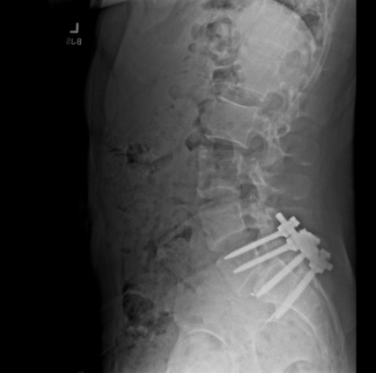 _blorg_'s tweet photo. Judging from the X-ray photo in his banner, I think I can guess why Luigi Mangione shot the UnitedHealthcare CEO https://t.co/oTz3uejnaU