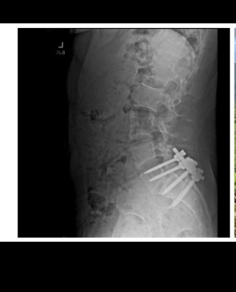 Spoke with a source that had a lot of friends that went to high school with Luigi Mangione. 

What keeps coming up is a back surgery that “changed everything” for him and he went “absolutely crazy.”

Checks out with his GoodReads history and the X-Ray in his header.