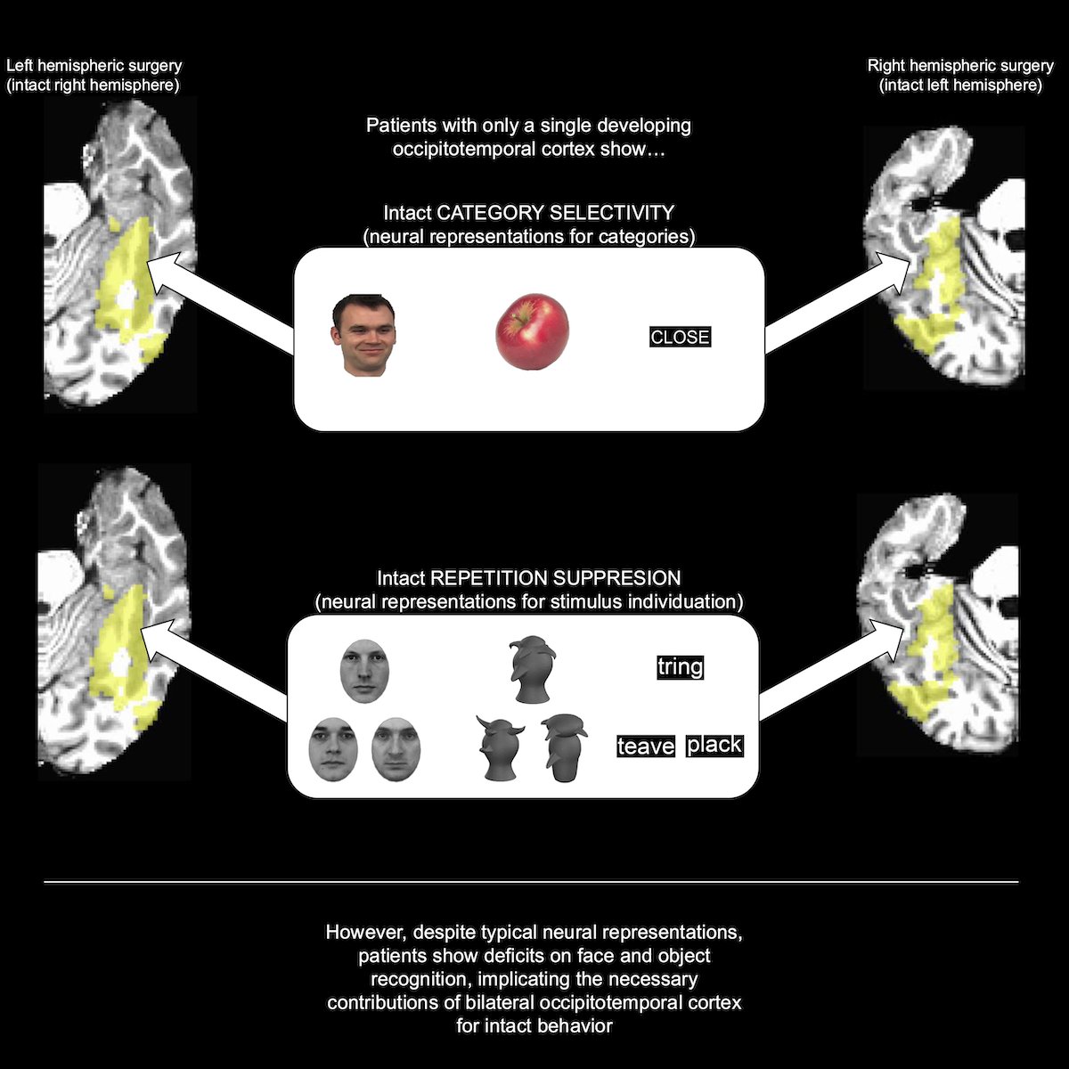 Michael Granovetter, MD PhD (@mgranovetter) on Twitter photo New paper out in <a href="/iScience_CP/">iScience journal</a>!
We show that children with unilateral occipitotemporal resection show intact neural processes for face/object/word individuation in preserved cortex, attesting to resilience of the developing brain.
Full thread to follow!
cell.com/iscience/fullt… New paper out in <a href="/iScience_CP/">iScience journal</a>!
We show that children with unilateral occipitotemporal resection show intact neural processes for face/object/word individuation in preserved cortex, attesting to resilience of the developing brain.
Full thread to follow!
cell.com/iscience/fullt…