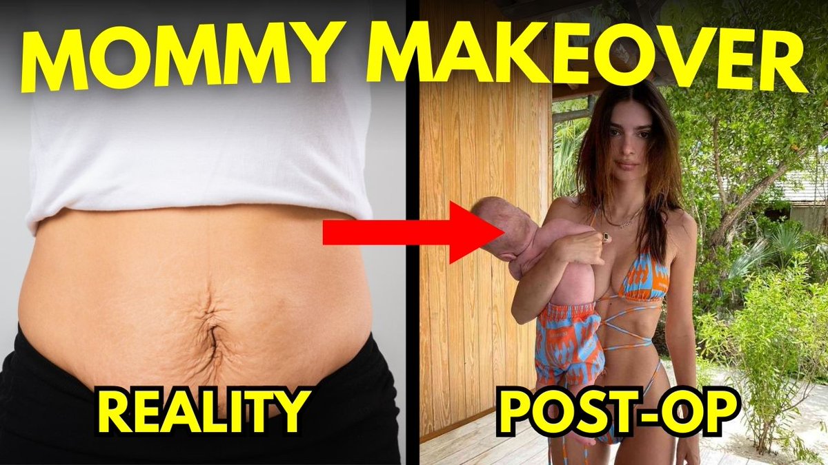 plastixdocs's tweet image. 🚨 New Episode! 🚨 Is a Mommy Makeover really worth it? 🤔 We’re breaking down the myths and facts in this True or False – from recovery time to results! 🎧 WATCH NOW to find out the truth! l8r.it/mmzc #MommyMakeoverResults #PlasticSurgery #PostBabyBody #MomLife