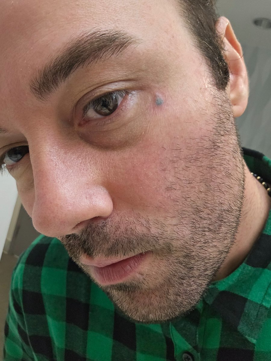 Starting my laser removal of my tear drop tattoo <a href="/removery_us/">Removery</a> 

#me #tattooremoval #removeryus