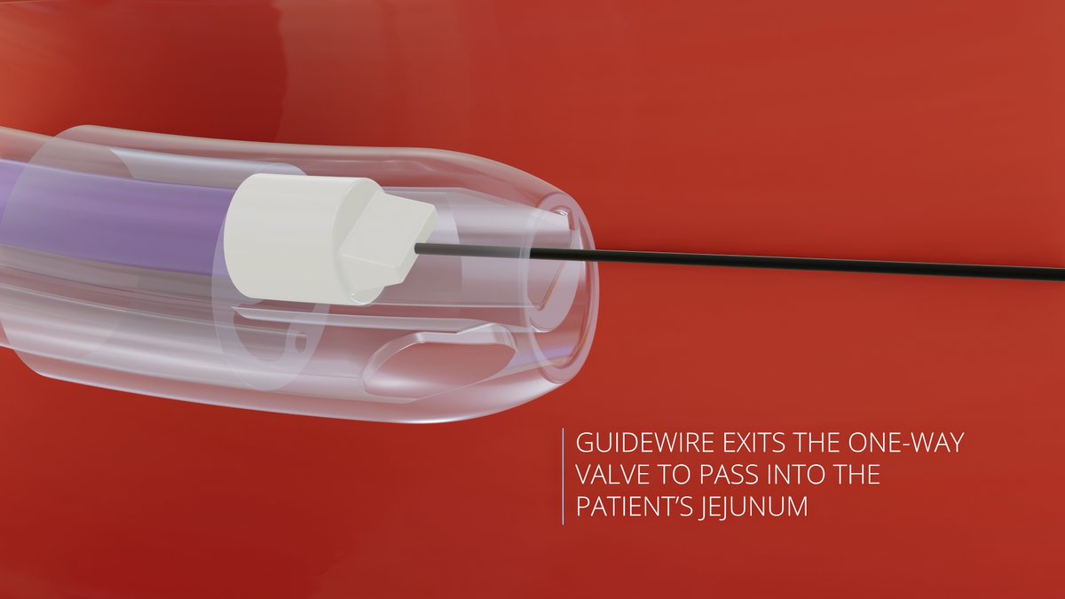 HatchMedical's tweet photo. INMed Inc. 's ShortCut™ GJ feeding tube with an innovative embedded sealed bypass exchange catheter ensures GJ  tube replacements are rapid regardless of jejunal (J) lumen blockage. 

Watch the video:
https://t.co/uJ0AF7g2kr

Contact us for more info! https://t.co/Jv0ElUIkxi