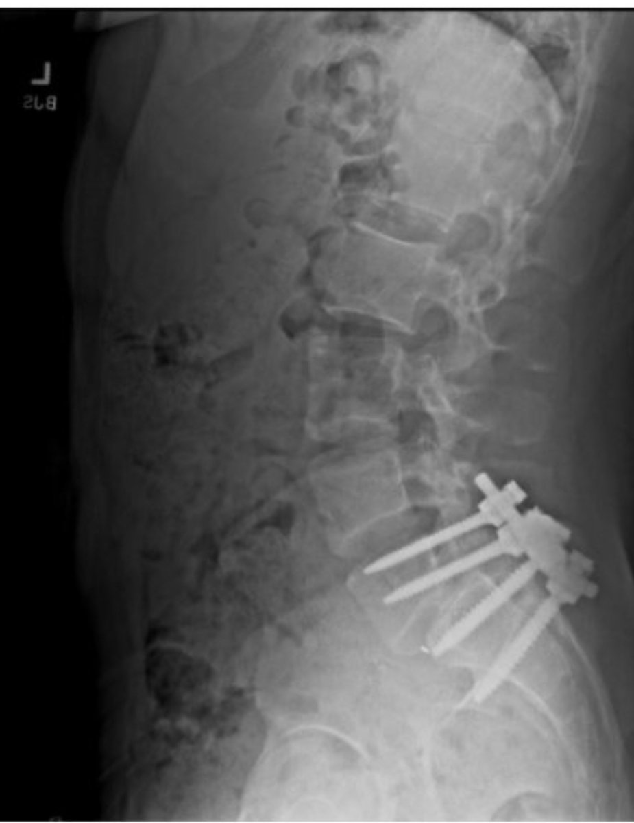 hamids's tweet photo. Huh. According to ChatGPT the x-ray on @PepMangione profile:

It appears to be a side-view (lateral) X-ray of someone’s lower spine, likely the lumbar region, showing metal screws and rods that are part of a spinal fusion or stabilization procedure. The hardware suggests that the person had back surgery, possibly to address issues like disc degeneration, instability, or a previous injury. Without further context or a professional’s interpretation, that’s about all I can confidently say.