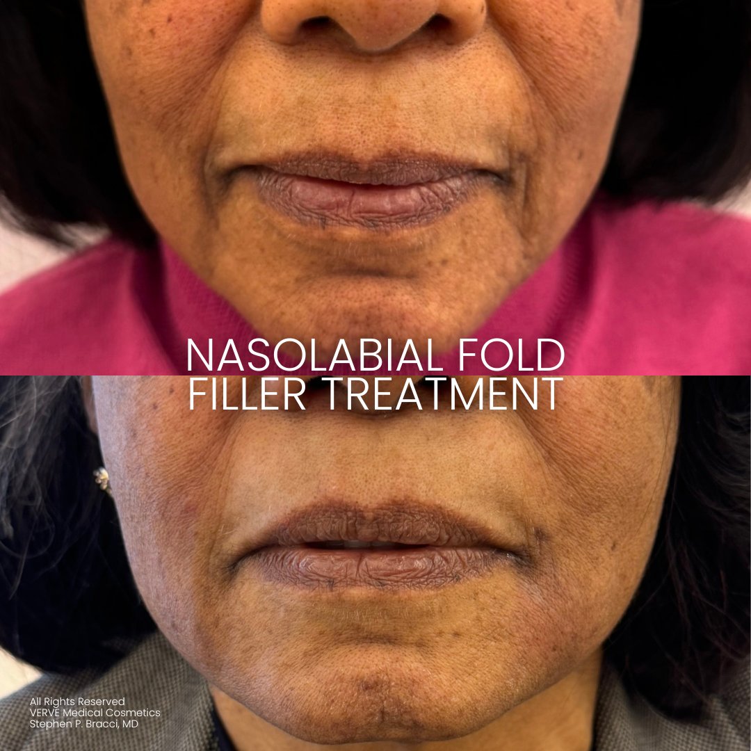 VerveCosmetics's tweet photo. Nasolabial folds or smile lines are the lines and wrinkles that run from the sides of the nose to the corners of the mouth, often deepening with age due to changes in skin elasticity and more from facial volume

Schedule a consultation with Dr. Bracci at https://t.co/maKt03IIFd https://t.co/1At5kmuBSY