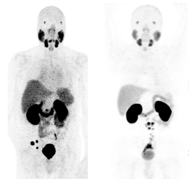 Ravi A Madan M.D. (@dr_ravimadan) on Twitter photo #PSMA imaging is showing #ProstateCancer in a WAY never seen before but it is unlikely to be showing Prostate Cancer that we have never encountered before
The presumption of the latter leads to aggressive therapy which may not be required
More data on this coming from <a href="/theNCI/">National Cancer Institute</a> #PSMA imaging is showing #ProstateCancer in a WAY never seen before but it is unlikely to be showing Prostate Cancer that we have never encountered before
The presumption of the latter leads to aggressive therapy which may not be required
More data on this coming from <a href="/theNCI/">National Cancer Institute</a>