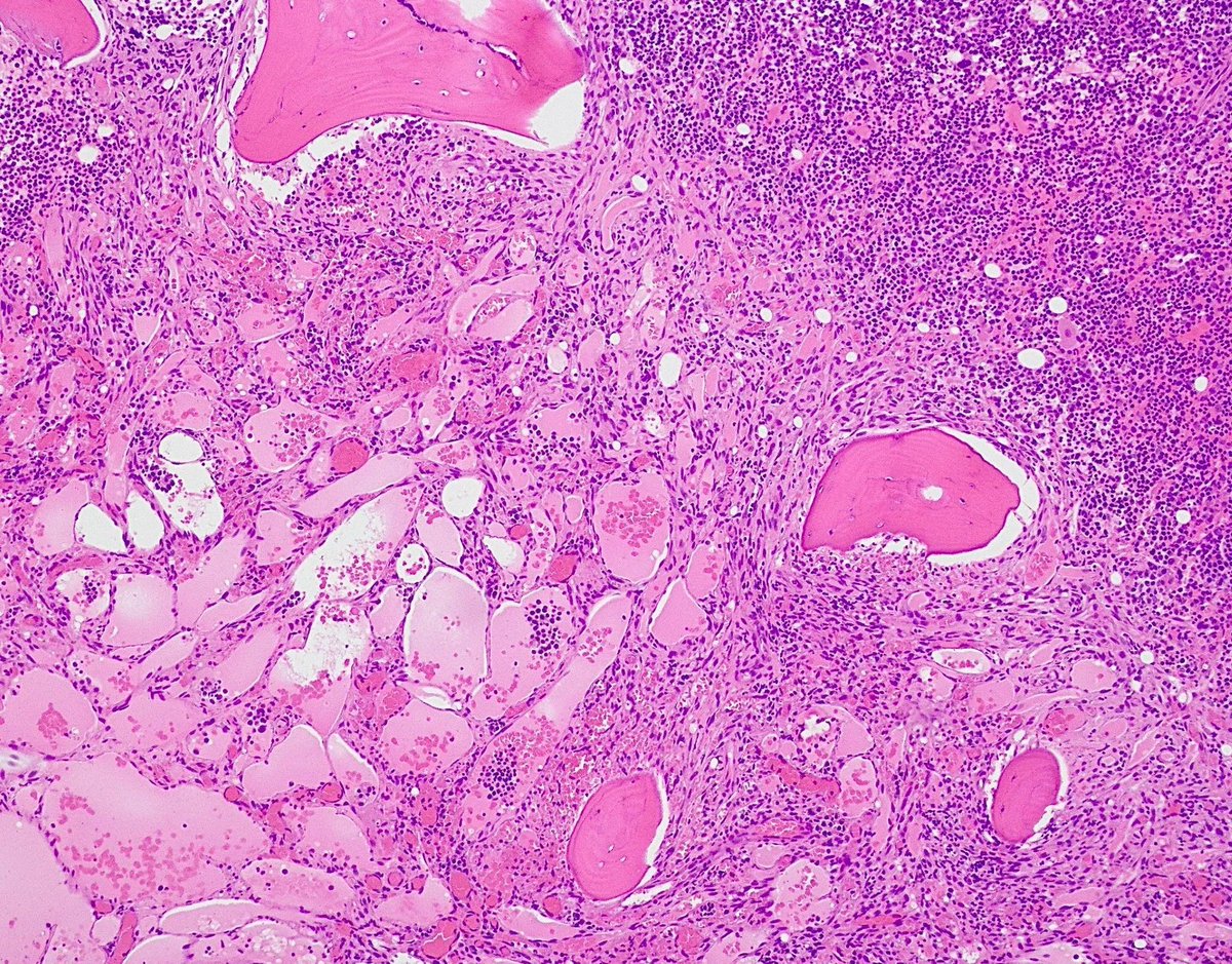 Gloria_SuraMD's tweet photo. Bone marrow biopsy from a patient with untreated HIV revealing involvement by Kaposi sarcoma. Spindled tumor cells are seen forming irregular, dilated vascular spaces. What stain is positive in tumor cells? Answer: https://t.co/kVRFuxySYb   #PathTwitter #PathArt https://t.co/XSLniv7bnT