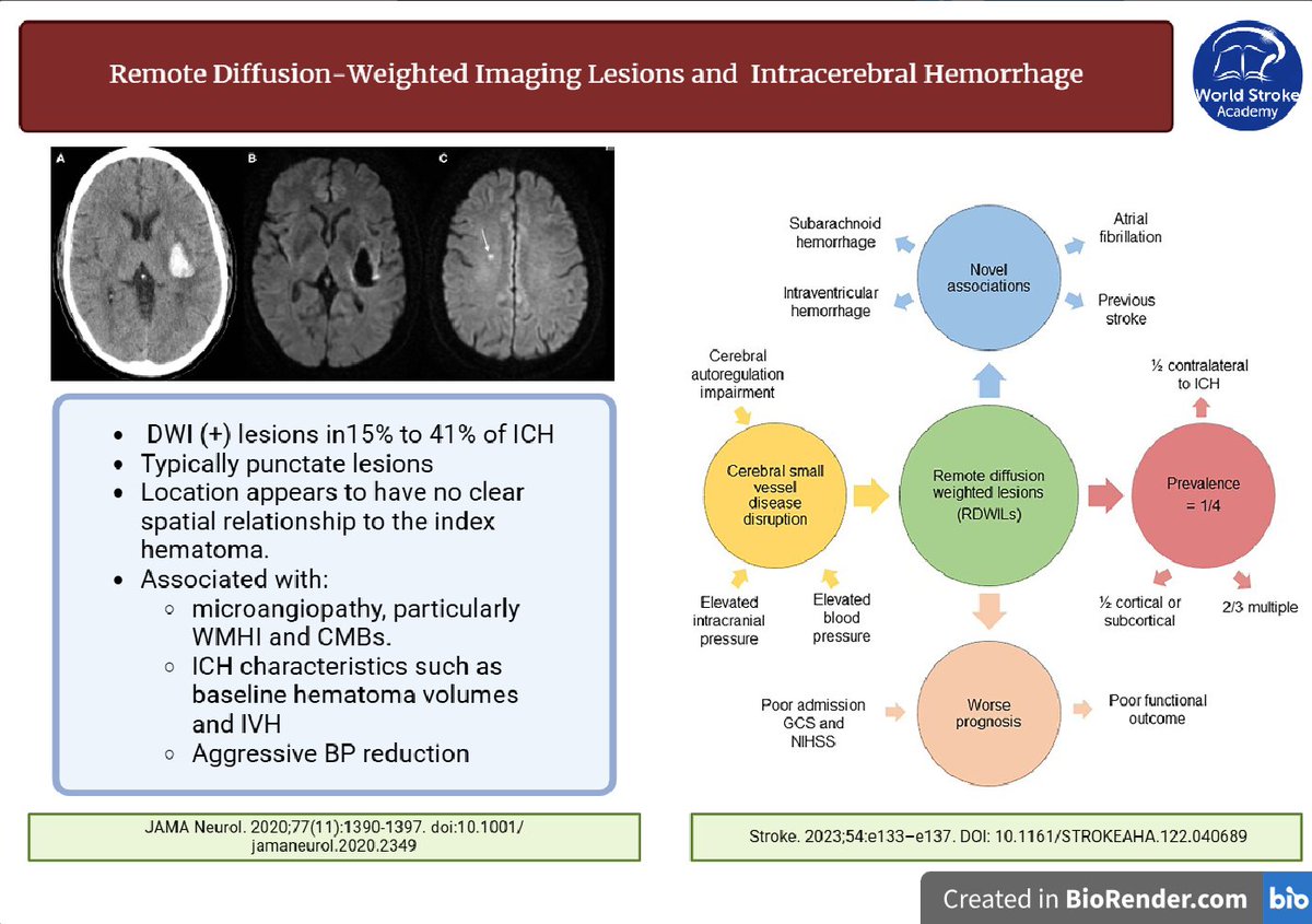 #MondayTip 🚨
🧠 Remote DWI+ lesions in ICH 🩸
🔹 ~30% of ICH cases show DWI+ lesions
🔹 Associated with chronic HTN, microangiopathy &amp; impaired autoregulation
🔹 Occur 2-4 days post-admission ⏲️
🔗 Indicate worse prognosis &amp; higher ischemic stroke risk
tinyurl.com/yvd4n5ay