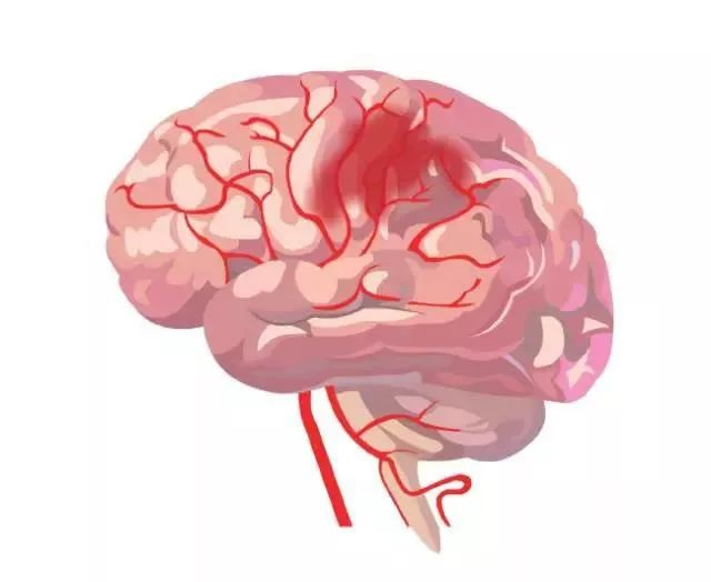 HainanJournal's tweet photo. Blood levels of Hepc25, SMAD3, and IRAK4 can predict the risk of brain bleeding after stroke treatment, with the combined test being more accurate!
#blood #stroke #brain 
@HainanJournal 
https://t.co/bX4ZNVJcoe https://t.co/HCHhavQDli