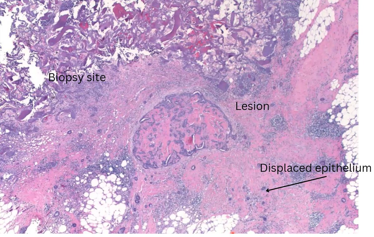 Janiranavarro's tweet photo. Breast-biopsy site
If the index lesion is benign (this case is an intraductal papilloma) be very wary of calling the displaced epithelium as invasive carcinoma 

The displaced epithelium should be confined within the fibrosis/biopsy site reaction

Dr. Lerwill CCSP24  #pathology #pathologists #PathTwitter #PathX #pathresidents #pathfellow #breastpath