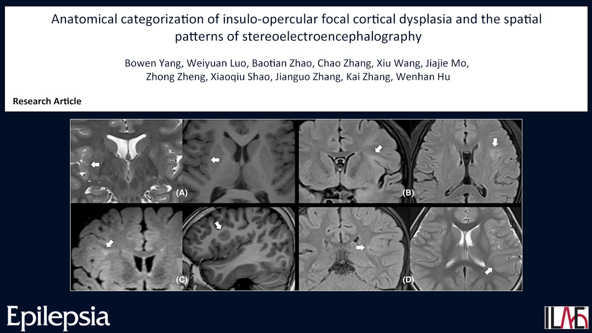 Epilepsia (@epilepsiajourn) on Twitter photo Key point: Insulo-opercular FCD lesions can be categorized based on location and extent into insular, peri-insular, opercular, and complex types.
doi.org/10.1111/epi.18…
#epilepsy #ILAE #clusteranalysis #focalcortical dysplasia #SEEG <a href="/IlaeWeb/">International League Against Epilepsy</a> <a href="/WileyNeuro/">Wiley Neuro</a> @epilepsiajourn Key point: Insulo-opercular FCD lesions can be categorized based on location and extent into insular, peri-insular, opercular, and complex types.
doi.org/10.1111/epi.18…
#epilepsy #ILAE #clusteranalysis #focalcortical dysplasia #SEEG <a href="/IlaeWeb/">International League Against Epilepsy</a> <a href="/WileyNeuro/">Wiley Neuro</a> @epilepsiajourn