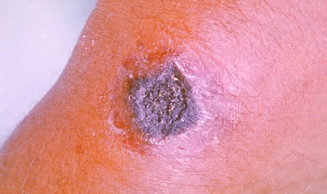 drAmyraa's tweet photo. Eschar present in - 
1)Scrub typhus ( h/o ) renal damage or creatinine will be given ( pyq)
2)anthrax ( black eschar as in img below)
3) R . Akari 

Not present in KFD ( pyq)

 #NEETPG #neetpg2024 #neetpg2025 #NEETUG #NEETPGcounselling2024 #neetug2025 #neet #MedTwitter #MedX https://t.co/zvEKVCOTSI