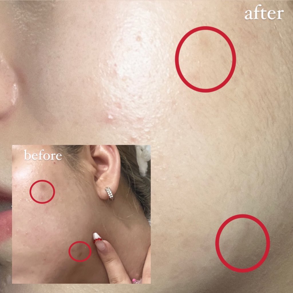 โฟมลดสิวของ CURA-MD สร้างเรื่องละ ยิ่งใช้คู่กับเจลแต้มสิวตัวดังคอมโบกันทาเช้าเย็น สิวยุบและรอยจางลงเยอะมากกกกกก ใช้มาสักพักละรู้สึกว่า ผิวแข็งแรง+หน้าไบร์ทขึ้นด้วย ใครมีปัญหาเรื่องสิวหรือรอยสิว ควรตุนสุดๆ เพราะทั้งถูกและดี 🥹🫶🏻 https://t.co/u8cLbv8gEp