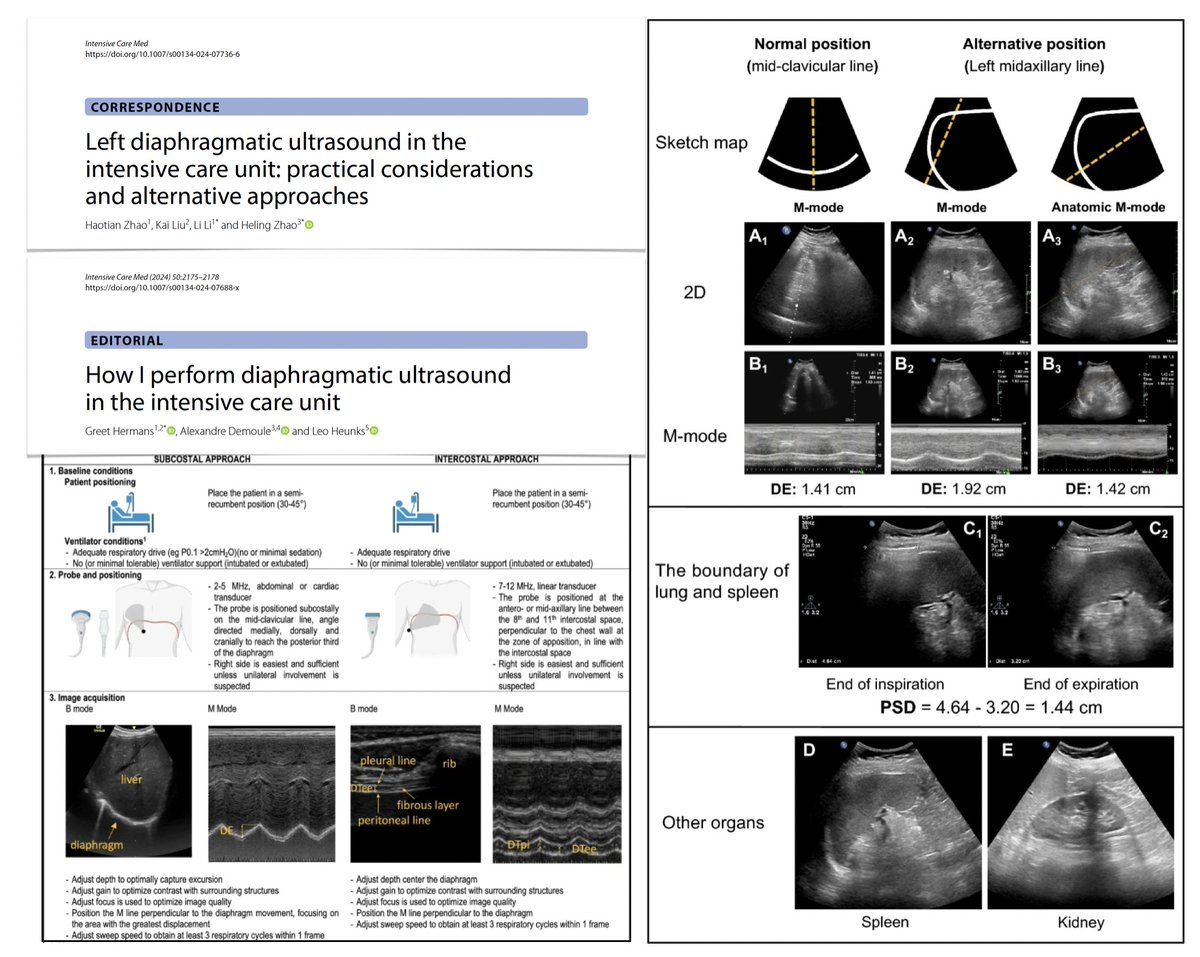 🖥️Diaphragmatic ultrasound essential for assessing diaphragm function in #ICU! Here practical considerations/alternative approach to furtherly improve technique #FOAMus #echofirst
🔓rdcu.be/d3QBA

On editorial on how to perform diaphragm #POCUS
🔓rdcu.be/d3QRG