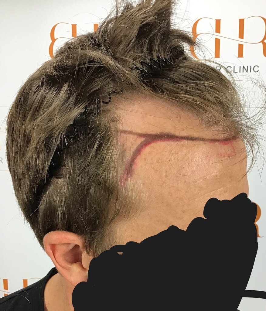 BHRClinic's tweet photo. 🚨 So Many Things to Unpack!🚨
Careful harvesting, precision tools, stringent protocol, fast healing!
Dr. Bisanga, Dr. Kostis, Dr. Abby, and our talented Nurses &amp; Techs. 💉
💬 Patient's Quote:
"The whole team is highly trained and makes the experience smooth and professional." https://t.co/zZOz581yP0