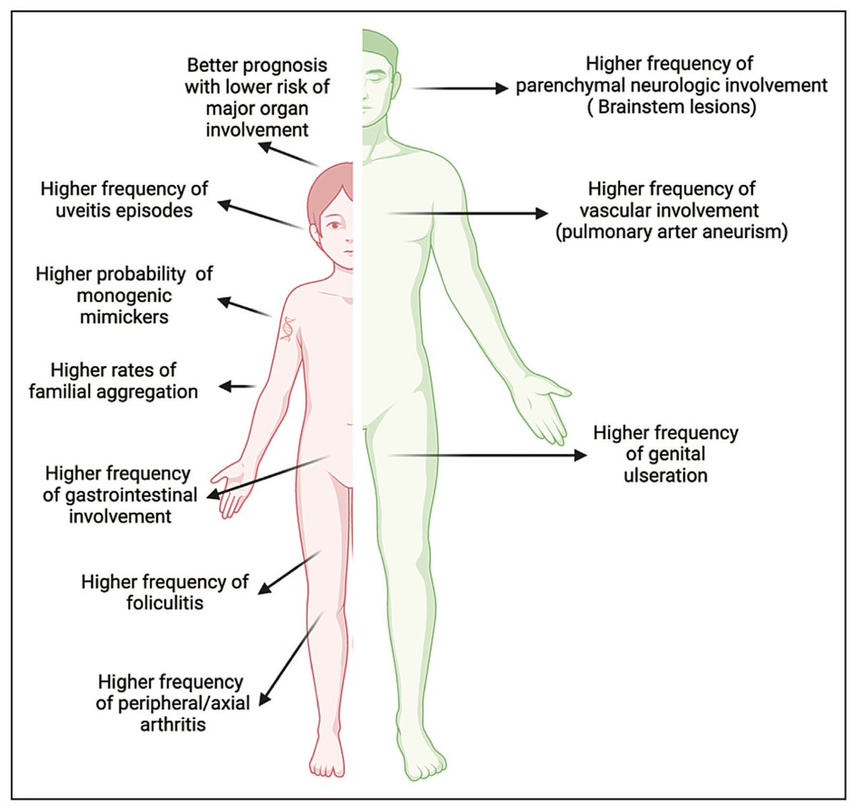 Major organ involvement, such as ocular, vascular, and neurological issues, is often influenced by the age of onset in #Behçet’s disease (BD), with these conditions frequently observed before the age of 25.

Recent comparative studies indicate that peripheral and axial arthritis,