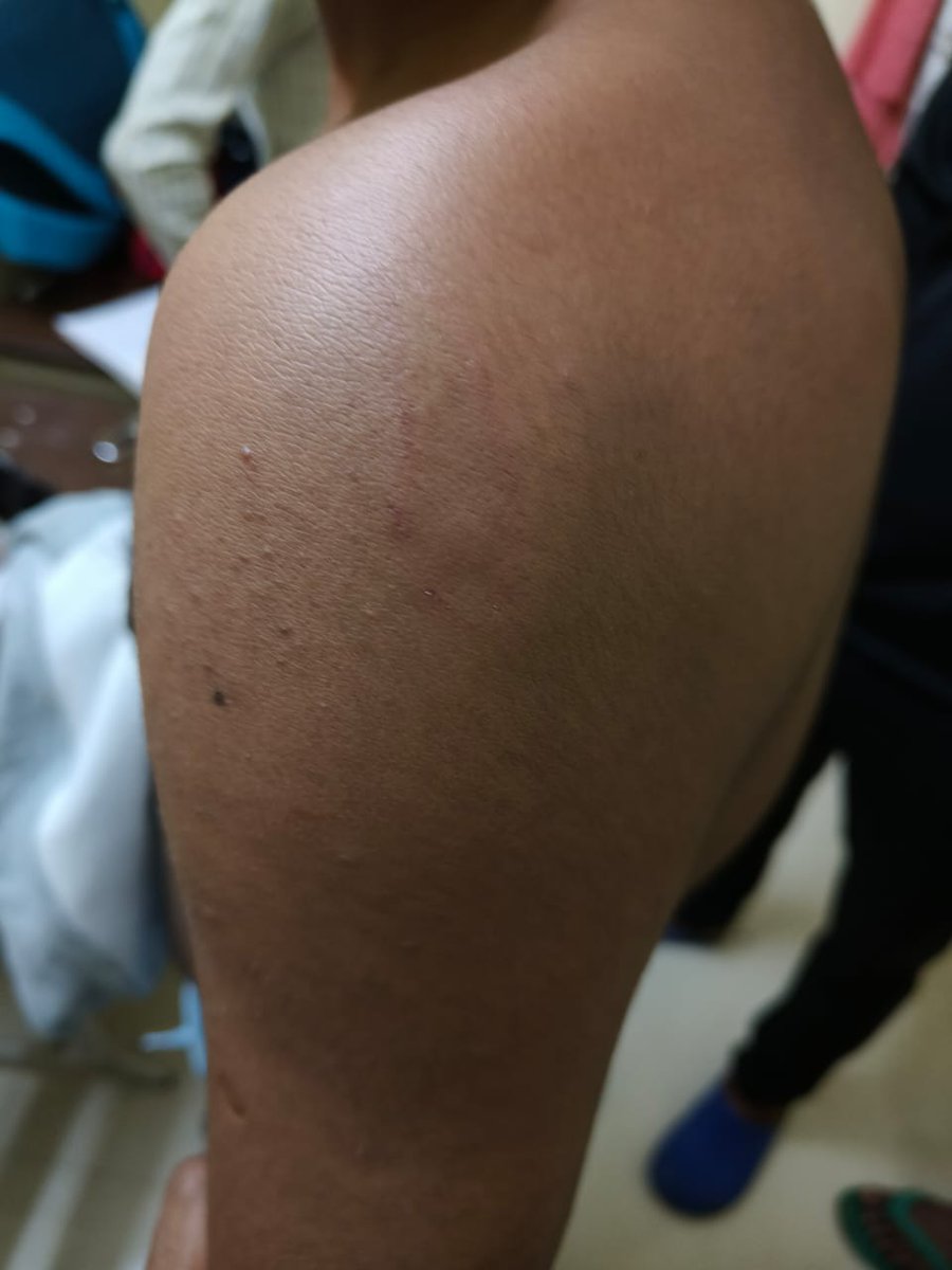 SourabhBhartiM2's tweet photo. छात्र मदद कि गुहार लगाते रहे,और पुलिस गुमराह करते रहे।बांका थाना
मामला इंजीनियरिंग कॉलेज बांका, लकड़ीकोला, का है तीन जुनियर को शराब पीकर बेरहमी से पिटा गया और पुलिस से सुरक्षा मांगने पर बार-बार यही बोला गया कि पढ़ाई करने आए हो या दादागिरी करने।
@bihar_police https://t.co/zho175Gx4R