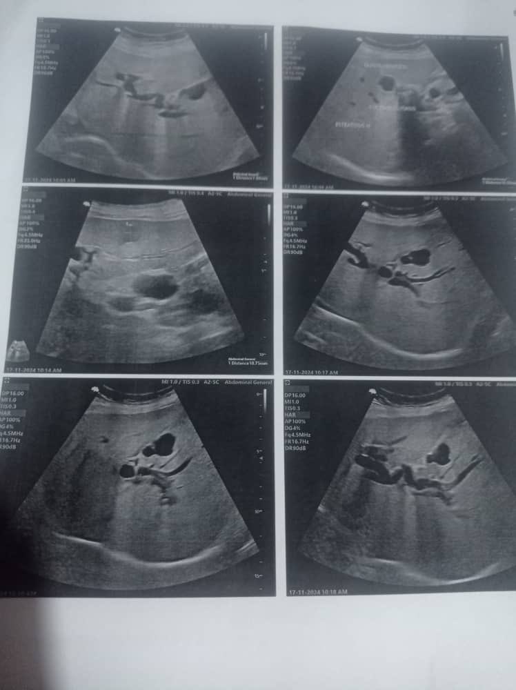 AlexaGomezDos's tweet image. Buenas noches. La señora Pascuala Herrera, tiene 64 años, es paciente con diabetes tipo2 y presenta cálculos en el conducto biliar . Debe realizarse una CPRE y dicho estudio tiene un costo de $1500 en la cruz Roja. Lamentablemente no cuenta con los recursos y su familia nos envía…