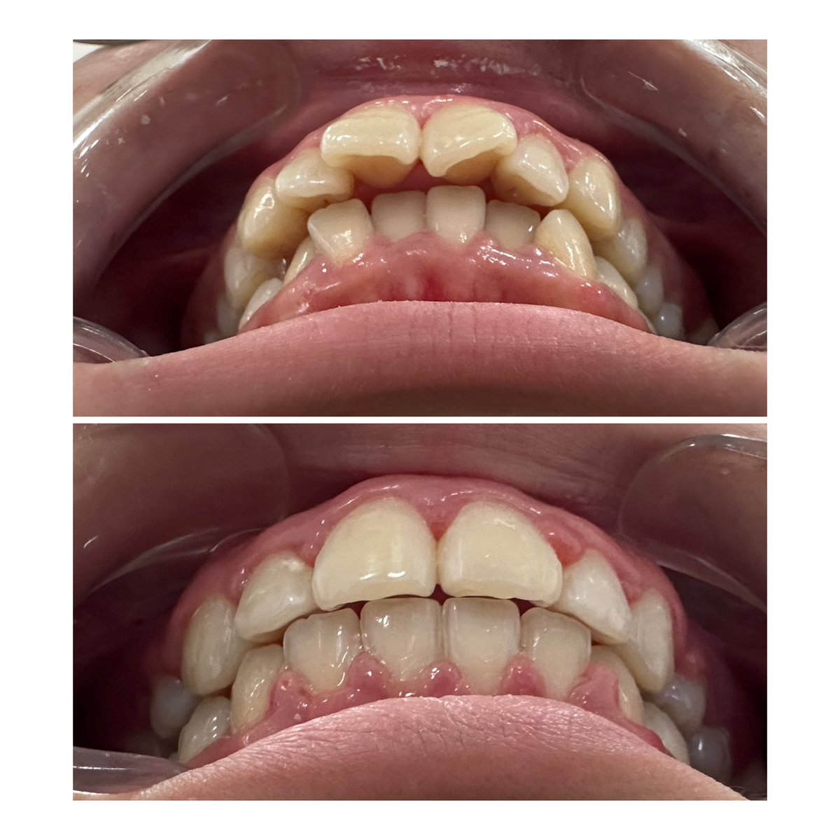 Утаа түгжрэл ханиад дундуур зүтгэн бж ажил дээрээ ирээд тэгширсэн хэдэн шүдээ харж л сэтгэл тэнийх юм даа хөөрхий 😅