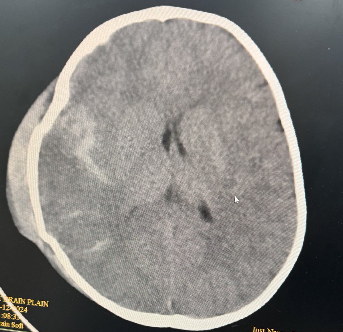 IsraLawatiEm's tweet image. #Whileatwork 
Ped head injury care 
1.SpO2 &amp;gt;92%
2.Art PCO2 of 35-45 mm Hg  &amp;amp; ETCO2 30-40 mm Hg
3. MAP 65 
4.Head elevated at 30 , 3% NS at 2.5-5 mL/kg or mannitol 0.5-1 g/kg IV.
5. Levetiracetam 20-40 mg/kg
Ps subglial in kids can cause anemia &amp;amp; coagulopathy