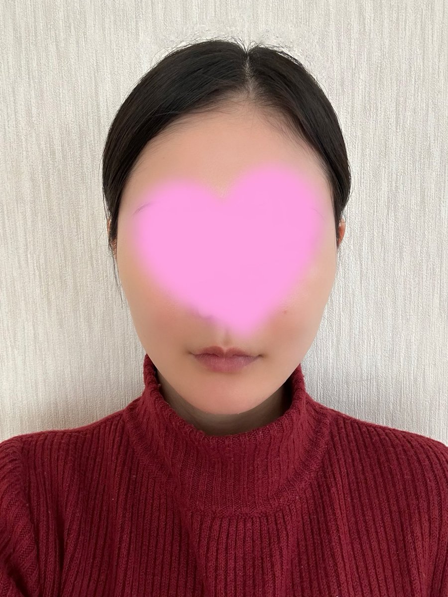 5agohen's tweet photo. ヤンユンドル口腔外科@2ydomfs さんで両顎・輪郭2点を受けてから6ヶ月が経ちました✨ https://t.co/hKLu6bPPFA