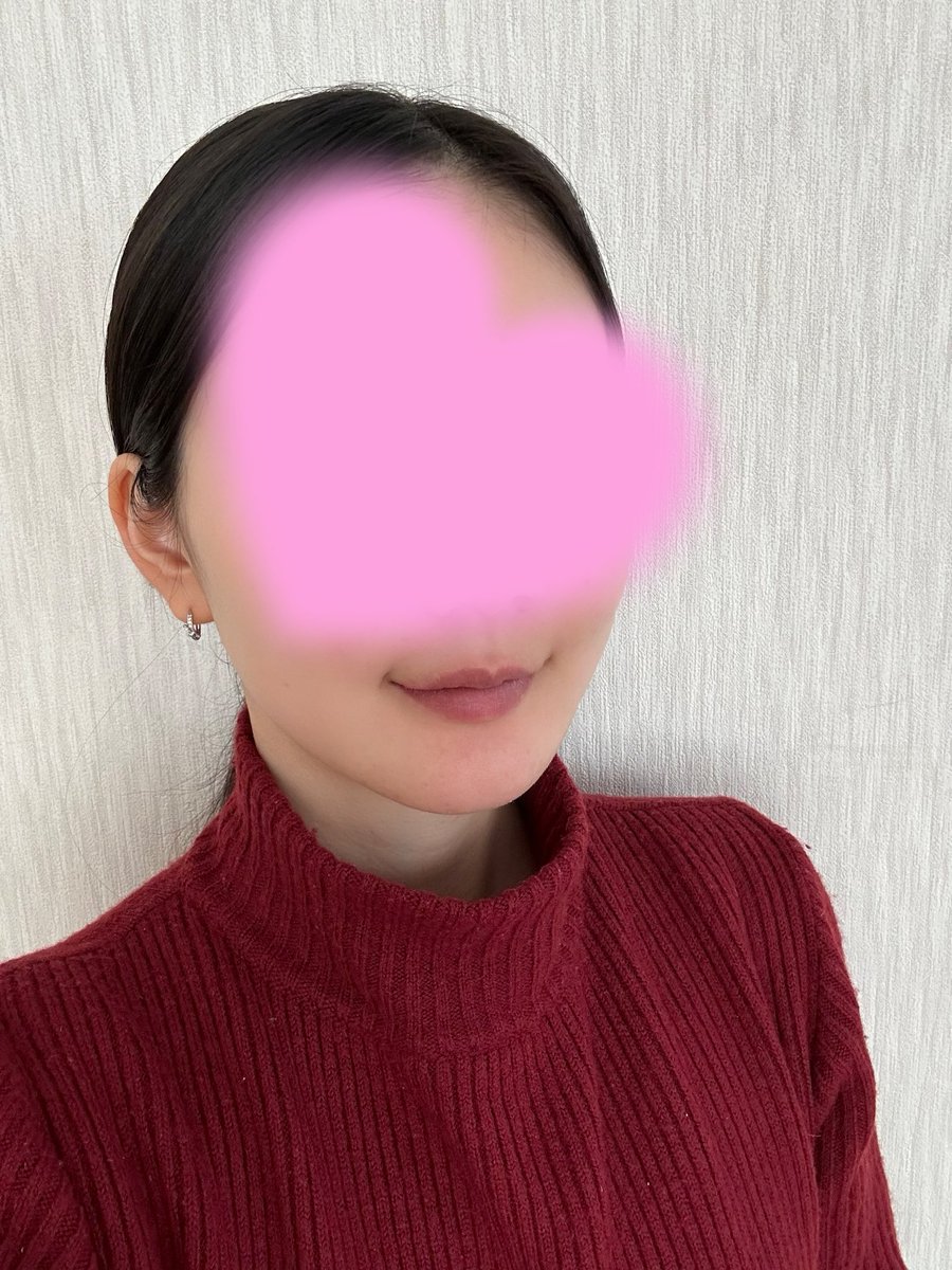 5agohen's tweet photo. ヤンユンドル口腔外科@2ydomfs さんで両顎・輪郭2点を受けてから6ヶ月が経ちました✨ https://t.co/hKLu6bPPFA