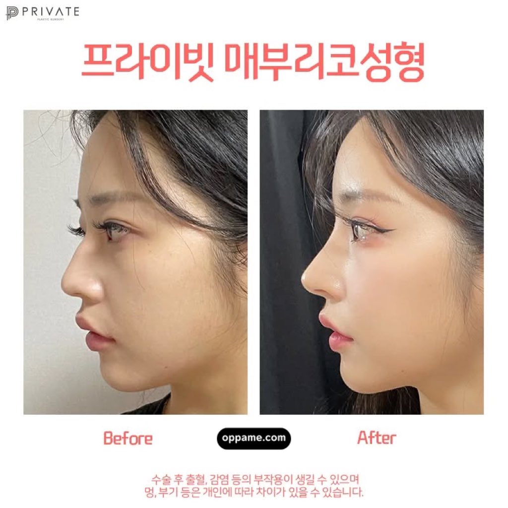 oppamethailand's tweet image. ลูกสาว ลูกชาย รพ.Private สไตล์การออกแบบที่เป็นเอกลักษณ์ “มีความละมุนแต่ยังคงความคมเล็กน้อย” เพื่อความน่าหลงไหล 

ศึกษาข้อมูลเพิ่มเติมได้ที่
oppame.com/post/โรงพยาบาลศัลยกรรมไพรเวท-privateplasticsurgery
#oppame #รีวิวศัลยกรรมเกาหลี #รีวิวบิวตี้ #ศัลยกรรมเกาหลี