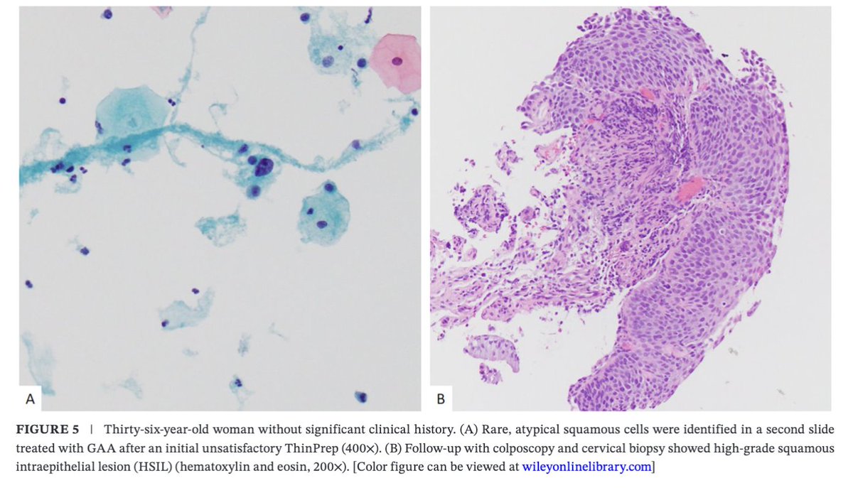 Diagnostic Cytopath (@diagnosticcyto) on Twitter photo New article alert! <a href="/DiagnosticCyto/">Diagnostic Cytopath</a> Reducing Unsatisfactory Pap Tests: Cytopathology QA Practice Improves Diagnosis and Detects Significant Lesions. onlinelibrary.wiley.com/doi/10.1002/dc… <a href="/mtsiddi/">Momin Siddiqui</a> <a href="/PapSociety/">Papanicolaou Society</a> <a href="/aakasharmand/">Zubair Baloch</a> <a href="/AzizaNassar2/">Aziza Nassar</a> <a href="/ekhanafshar/">Elham Khanafshar, MD, MS</a> @conniechenMD New article alert! <a href="/DiagnosticCyto/">Diagnostic Cytopath</a> Reducing Unsatisfactory Pap Tests: Cytopathology QA Practice Improves Diagnosis and Detects Significant Lesions. onlinelibrary.wiley.com/doi/10.1002/dc… <a href="/mtsiddi/">Momin Siddiqui</a> <a href="/PapSociety/">Papanicolaou Society</a> <a href="/aakasharmand/">Zubair Baloch</a> <a href="/AzizaNassar2/">Aziza Nassar</a> <a href="/ekhanafshar/">Elham Khanafshar, MD, MS</a> @conniechenMD