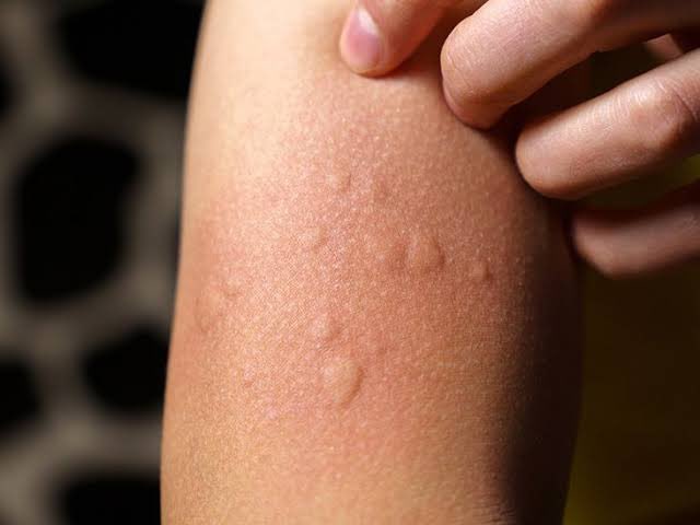 cholinergic-urticaria-causes-and-prevention-have-you-ever-experienced