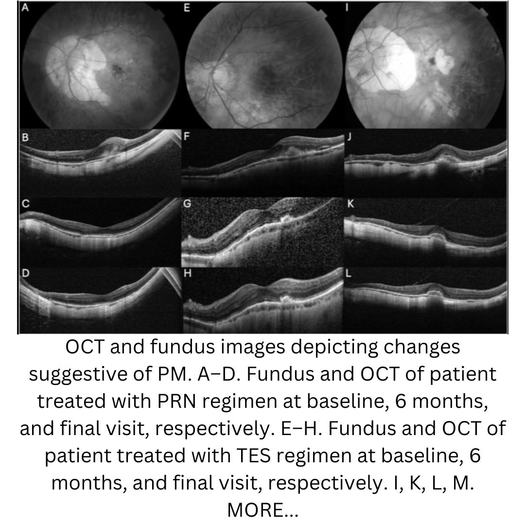 OUTCOMES OF PRO RE NATA VERSUS TREAT-AND-EXTEND ANTI-VASCULAR ENDOTHELIAL GROWTH FACTOR INJECTIONS FOR MYOPIC MACULAR NEOVASCULARIZATION IN MULTIETHNIC PATIENTS IN THE UNITED STATES
Swaminathan, Shreya BS;  et. al. 
#Retina 44(12):p 2057-65, Dec 2024
journals.lww.com/retinajournal/…
