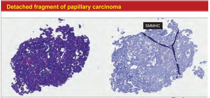 Janiranavarro's tweet image. Breast pathology
Biopsy with papillary proliferation, how to sign it out?

Papillary carcinoma, see comment
Comment: The differential diagnosis includes papillary DCIS, encapsulated papillary carcinoma or invasive carcinoma

Dr. Li #CAP24 #pathology #pathologists #PathTwitter
