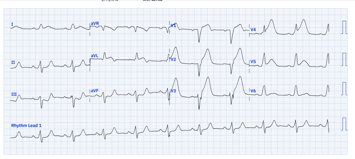 A 60-year old with left arm pain and shortness of breath. Known left bundle branch block (LBBB). What's your take?
Credit - <a href="/LITFLblog/">LITFL</a> 
#ecg #MedTwitter #Cardiology