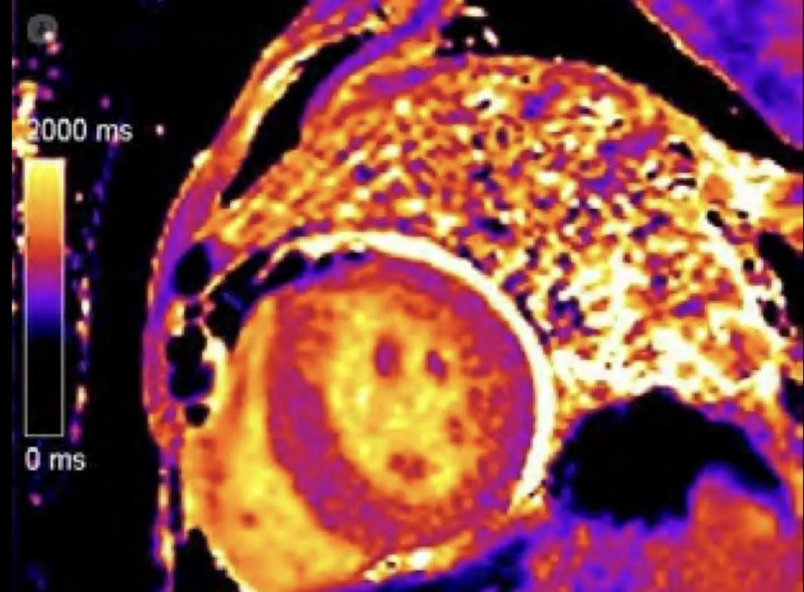 🎓Curso #CardioResonanciaMagnética 2⃣ Ed

🗓️11 diciembre

💡Aprende a realizar la técnica de imagen más precisa para valorar la anatomía y función cardíaca

👩‍⚕️🧑‍⚕️Proceso de la imagen de casos reales en estaciones de trabajo

🏥 H. Clínico San Carlos

🔗fundacionfic.es/evento/cardio-…