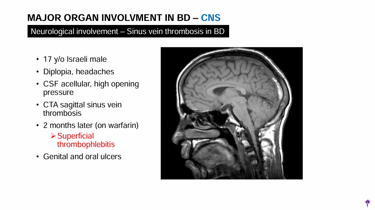 ERheumat's tweet photo. 7/10:
Neuro-Behçet's can involve parenchymal or vascular lesions, but not both together. GI involvement can mimic Crohn's, especially in East Asia. Pulmonary artery aneurysms are highly suggestive of Behçet's. 🧠#ACR24 #Behçets #OrganInvolvement https://t.co/rIfFzLbfhm